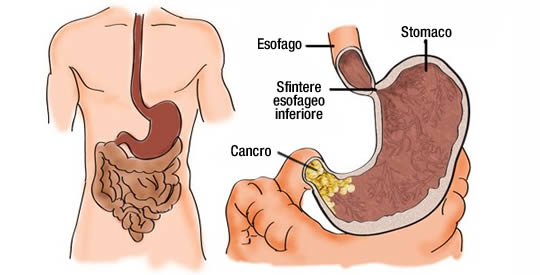 Cancro allo stomaco ecco perché viene quali i sintomi e cosa fare per evitarlo