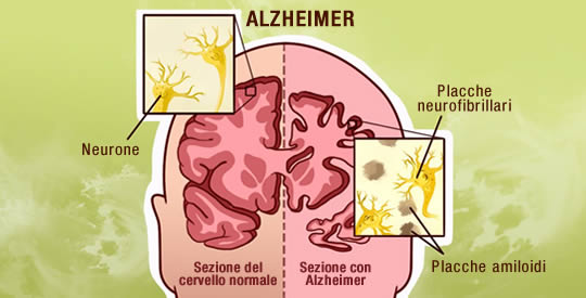 8 Cose Che Puoi Fare Per Prevenire L'Alzheimer